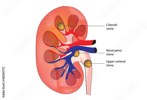 Biological illustration of kidney stones, origin of bladder stones urine stones, calcium stone inside kidney  