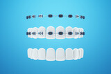 White teeth with metal braces on a blue background. Dental braces, orthodontic treatment, dentistry, teeth whitening, protection, oral care, hygiene, healthcare. 3D illustration, 3D render.