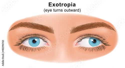 Squint eye (Strabismus). Exotropia, eye turns outward. Deflection of visual axes. Vector illustration.