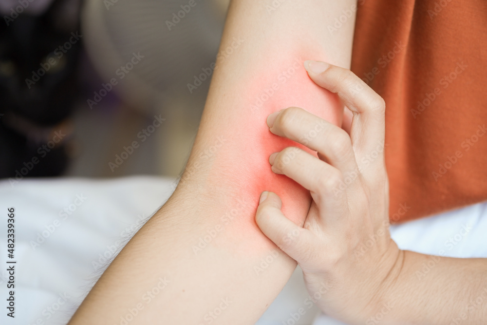 custom made wallpaper toronto digitalWoman scratching her arm because of itchy arm.