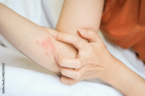 The woman had an itchy red rash on her arm, so she scratched from an insect bite.