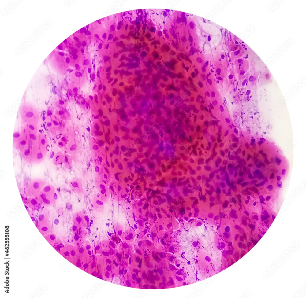 Pap's smear pap stain Microscopic 40x Zoom show High-grade squamous intraepithelial lesion is a pre-cancerous, sexually transmitted disease. Pap's smear pap stain Microscopic 40x Zoom show High-grade squamous intraepithelial lesion is a pre-cancerous, sexually transmitted disease.