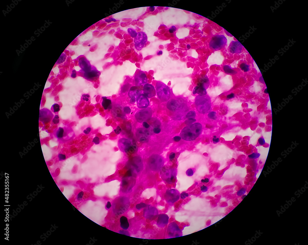 Photomicrograph of Metastatic adenocarcinoma of lung. Pleural fluid FNAC, 40X Photomicrograph of Metastatic adenocarcinoma of lung. Pleural fluid FNAC, 40X