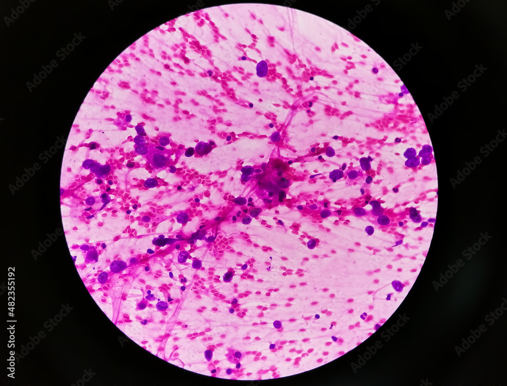 Photomicrograph of Metastatic adenocarcinoma of lung. Pleural fluid FNAC, 40X Photomicrograph of Metastatic adenocarcinoma of lung. Pleural fluid FNAC, 40X