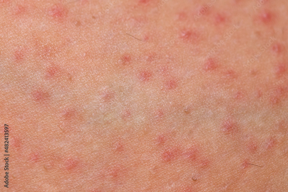 Folliculitis on female skin