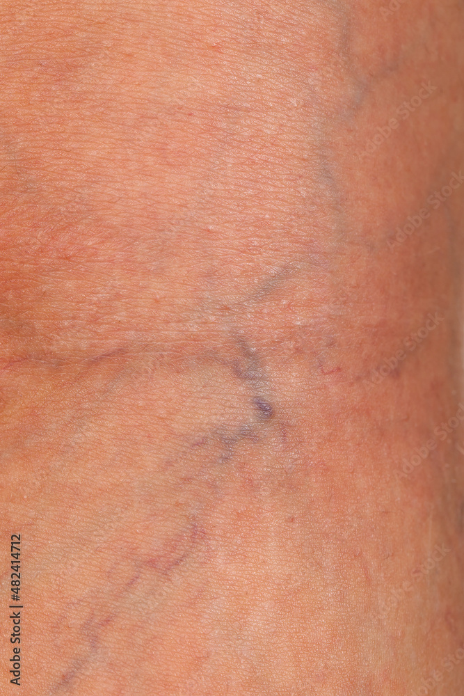 Fototapeta premium Varicose veins on female leg