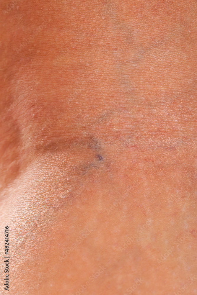 Fototapeta premium Varicose veins on female leg