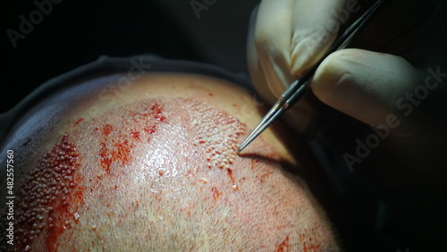 Close-up shot of hair transplantation procedure	