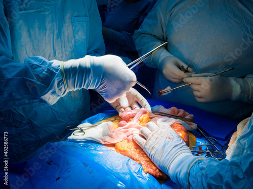 A team of surgeons performing abdominal surgery on a patient to remove a cancerous tumor in the intestines. Selective focus. Hands of surgeons during surgery on the abdominal cavity of a person.