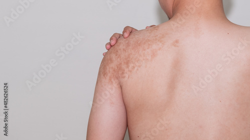 An asian man has a birthmark on the back of the shoulder. photo