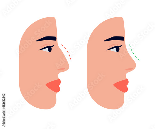 Face woman and correction of profile of nose, changing nasal shape during rhinoplasty surgery. Hump nose and straight nose. Vector illustration