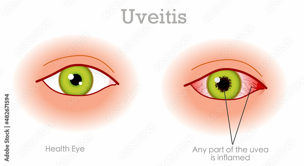 Uveitis anterior diagram. Pink, red infection eye symptoms. Bleeding