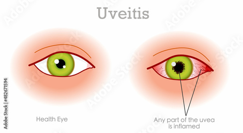 Uveitis anterior diagram. Pink, red infection eye symptoms. Bleeding, acute, inflammation uvea eyes. Normal, health, green iris eye. Ophthalmology medical draw. Graphic illustration vector photo