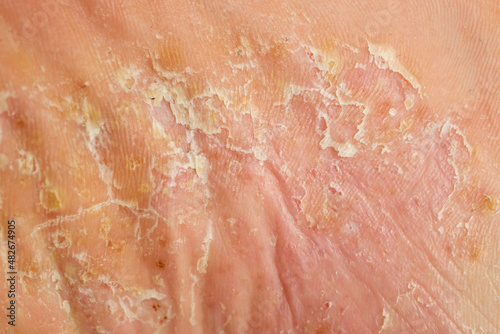 severe pustular psoriasis lesions on the sole of the foot