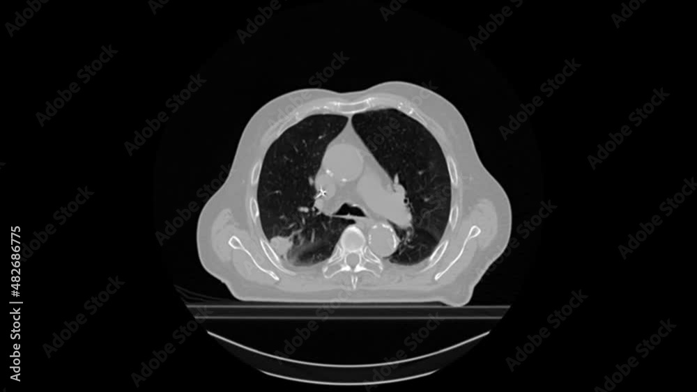 The upper body ct scan of a male patient reveals a subpleural lung ...