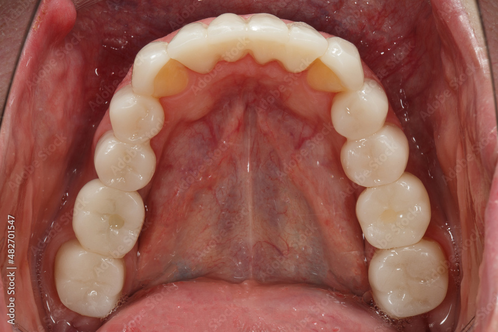 Dental crowns of the lower jaw after prosthetics, photos through the mirror