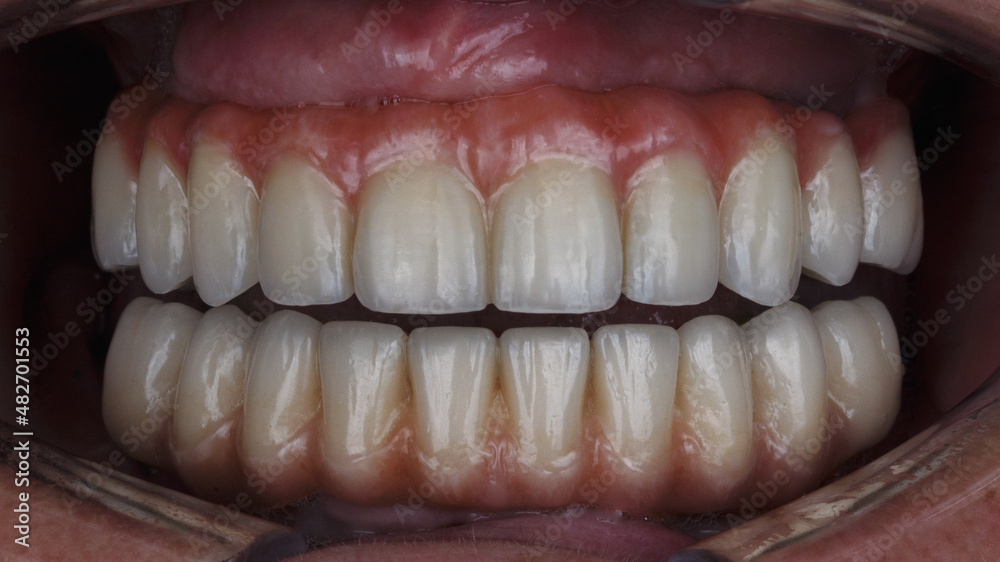 Excellent composition Dental Prostheses from titanium and ceramics in the oral patient Excellent composition Dental Prostheses from titanium and ceramics in the oral patient