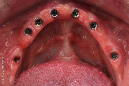 Seven mounted dentals implants in the gums
