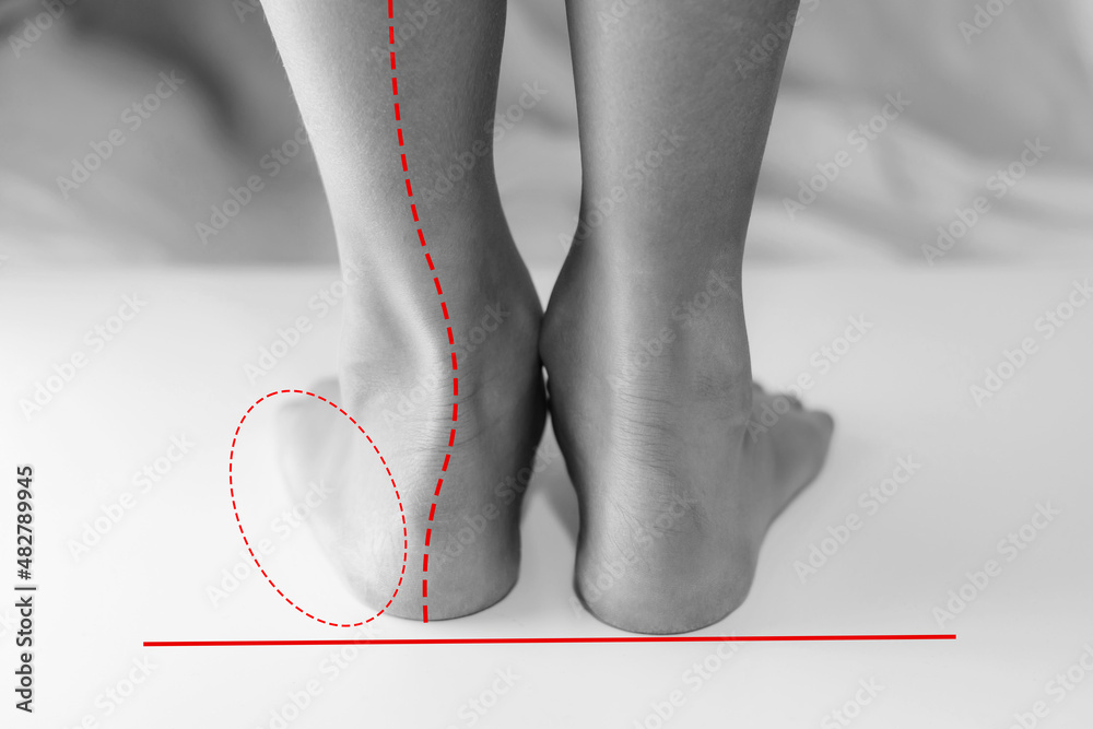 Stockfoto Boy's feet with flat feet or fallen arch, ankle lean inward