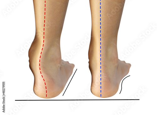 Boy's feet with flat feet or fallen arch, ankle lean inward causing leg length difference. The red line showing abnormal shapes flat foot compare to normal foot. photo