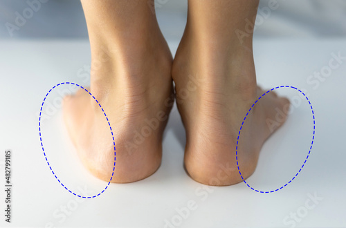 Compared flat foot shape with normal foot shape.