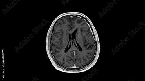 Magnetic resonance imaging (MRI) of a middle-aged male patient reveals a relevant residual tumor of a meningioma in the left wing of the sphenoid bone. 