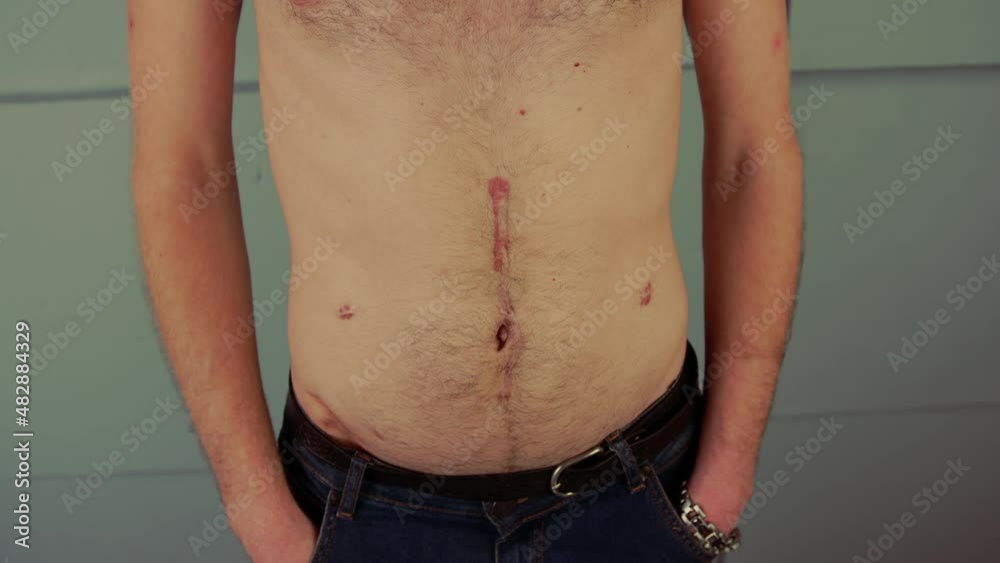 Vidéo Stock Anonymous shirtless man with scars on body. Crop ...