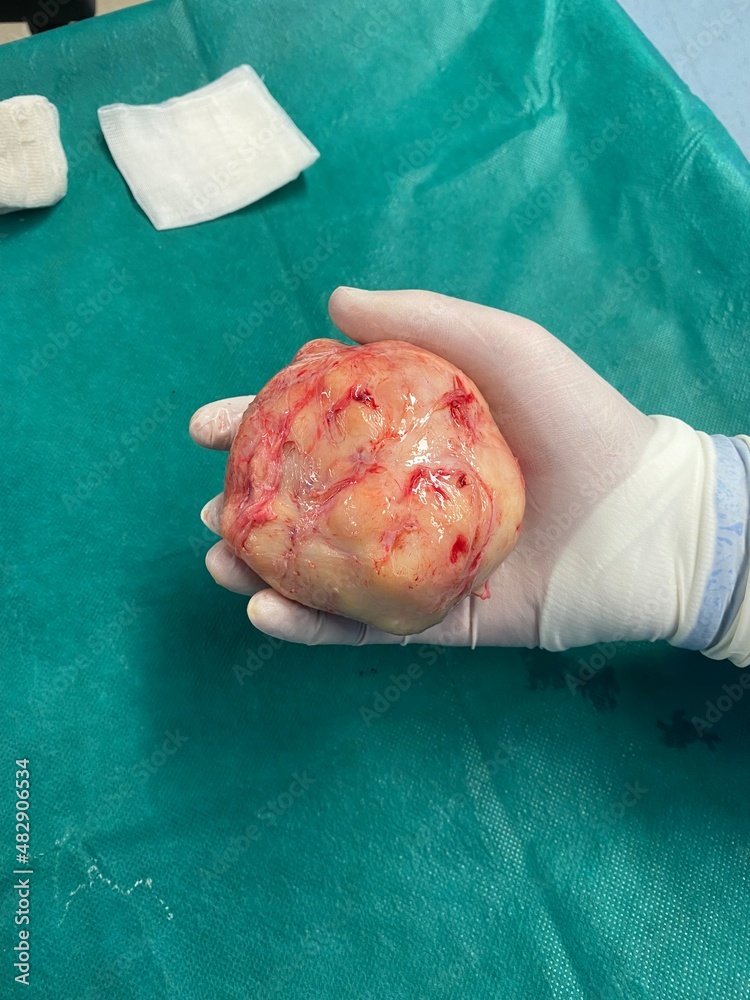 a large node of uterine fibroids after removal