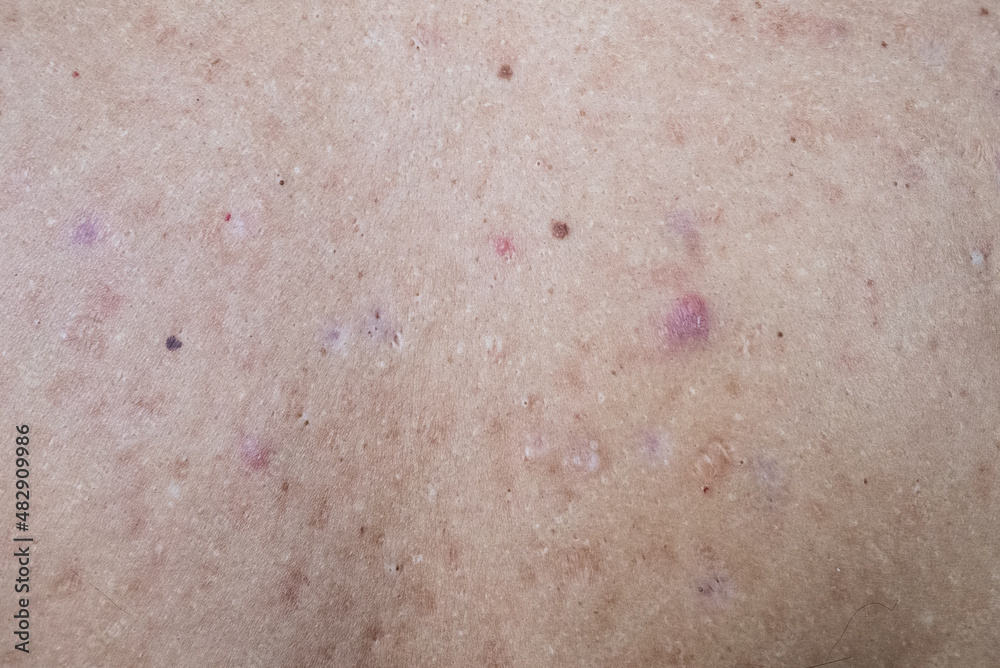 Pimples on the skin. Acne. Sore skin with pimples close-up