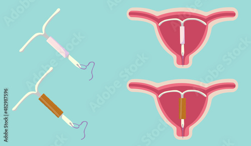 intrauterine device vector illustration