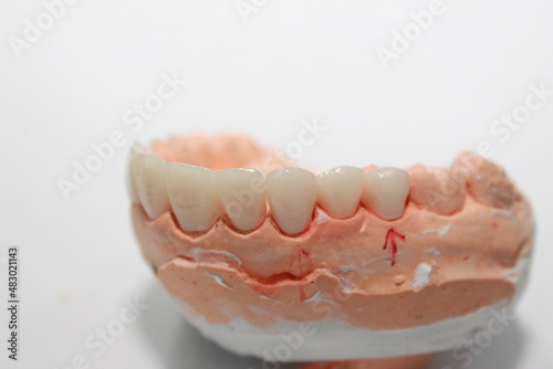 Veneers and crowns by dental technicians try-in the dental models before handing over to the patient insertion dentist.