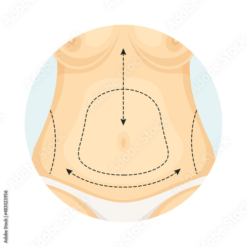 Cosmetic surgery on stomach with dotted lines. Abdominoplasty. Plastic surgery vector illustration