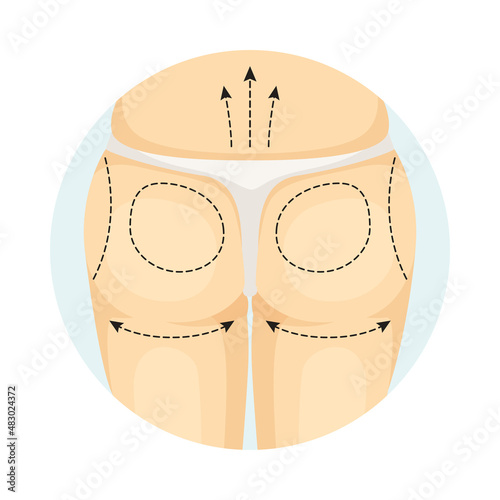 Cosmetic surgery on female body with dotted lines. Buttocks correction procedure. Plastic surgery vector illustration