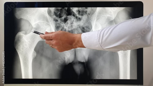 Doctor radiologist shows on the coxofemoral hip joint. X ray of coxofemoral hip joint.
