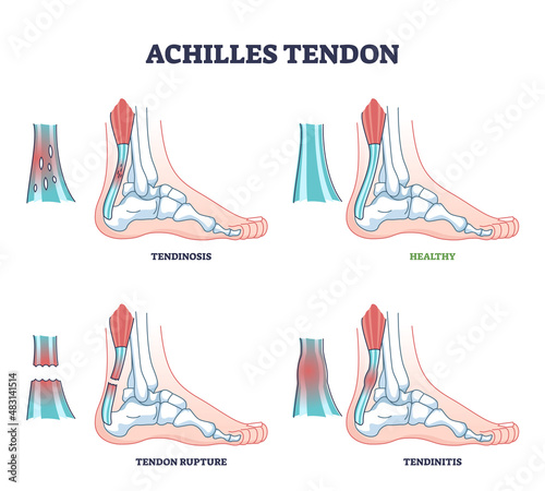 Achilles tendon injury as leg or ankle trauma outline diagram. Labeled educational inflammation and orthopedic ligament conditions vector illustration. Tendinosis, rupture and tendinitis problem. photo