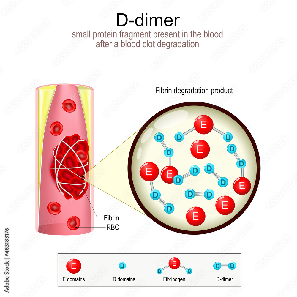 Ddimer formation. Blood vessel with blood clot.