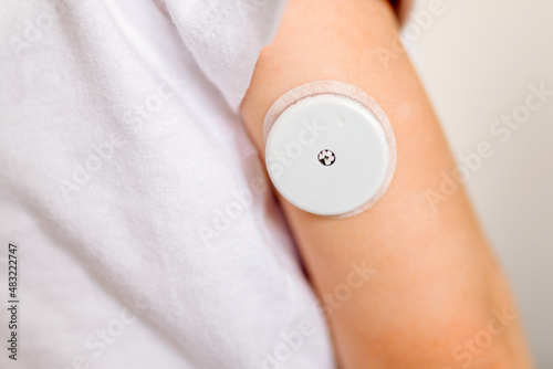 CGM -system of continuous monitoring of glucose on child's arm.