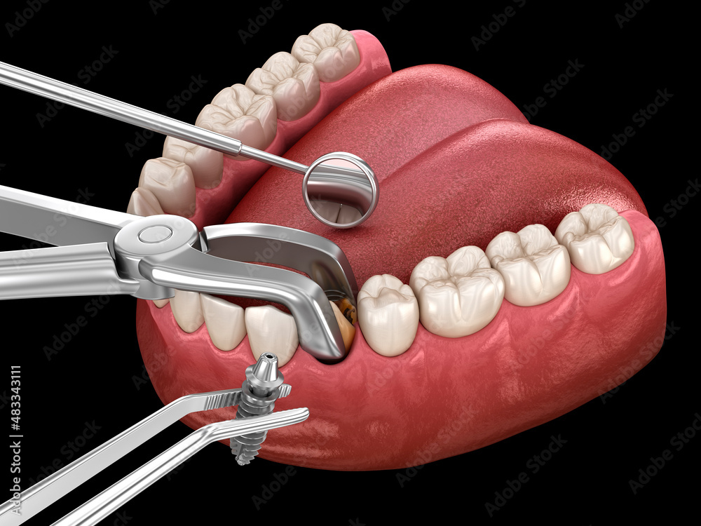 Extraction and Implantation, complex immediate surgery. Medically accurate 3D illustration of dental treatment - obrazy, fototapety, plakaty 