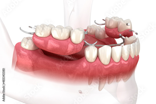 Removable partial denture, mandibular prosthesis. Medically accurate 3D illustration of prosthodontics concept photo