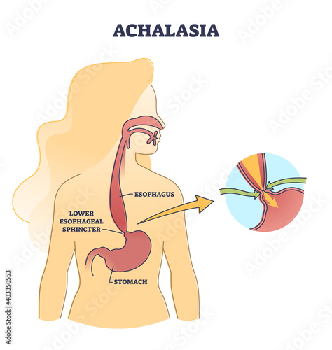 Esophageal achalasia disease with lower sphincter opening failure outline diagram. Labeled educational smooth muscle fibers condition explanation with failed valve closure symptoms vector illustration photo