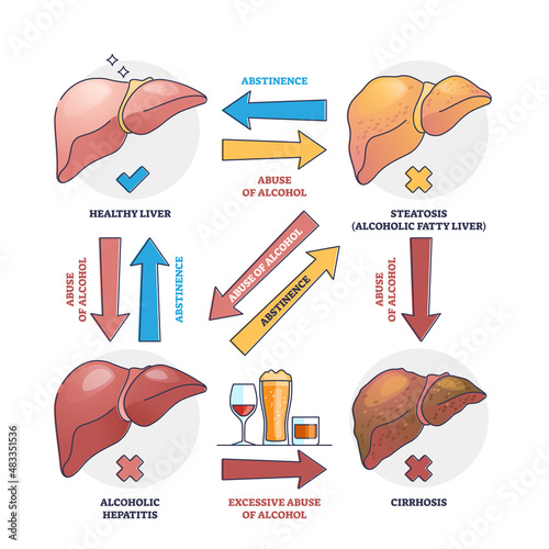 Alcoholic liver disease from excessive abuse of alcohol outline concept. Labeled educational scheme with abstinence causes, cirrhosis and hepatitis vector illustration. Anatomical impact of drinking.