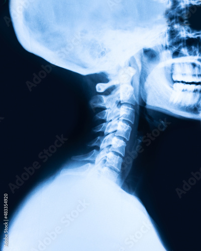 Ray x imaging of the cervical spine. MRI vertebral discs in different views