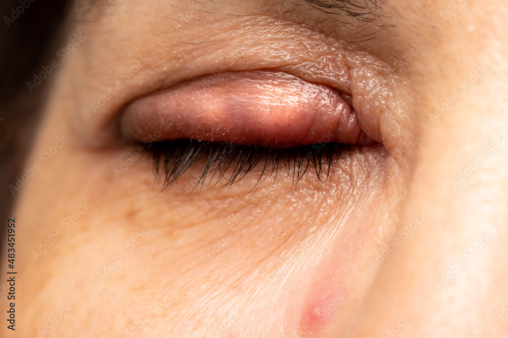 Fototapeta premium Woman eye with stye in her eyelid