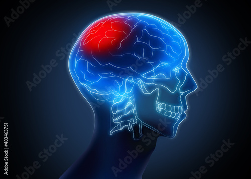 Scan of human brain with injured area on dark background, illustration