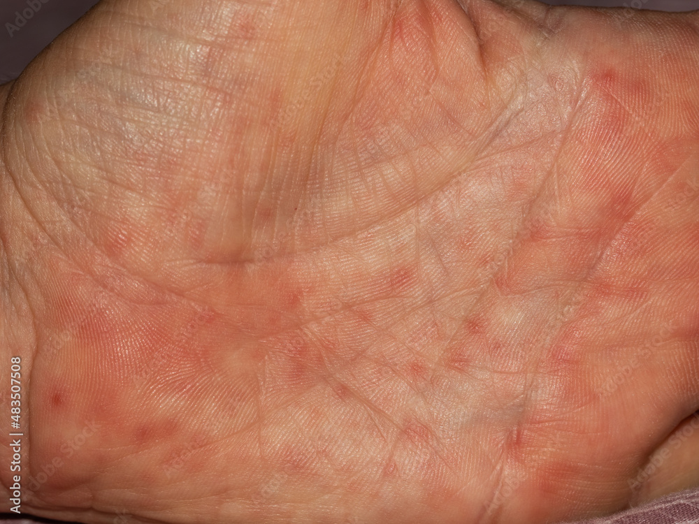 detail of scarlet fever in an adult caucasian man