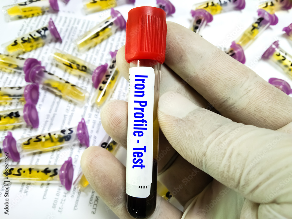 Blood sample tube for iron profile analysis in medical laboratory for