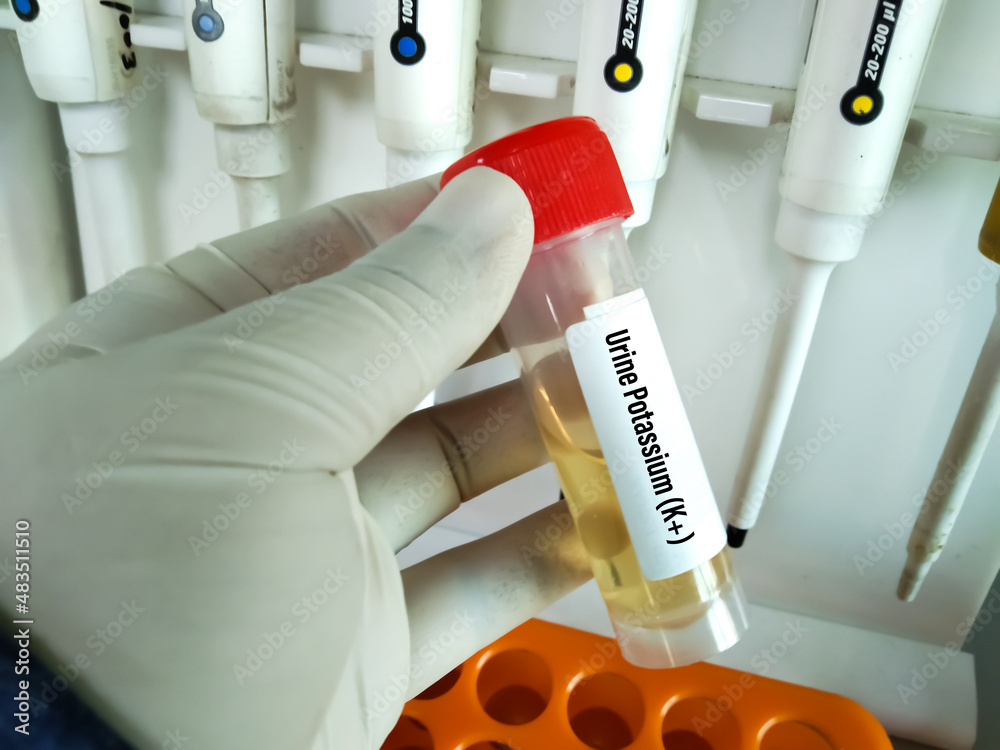 Urine sample for electrolytes test. Electrolytes are salts and minerals