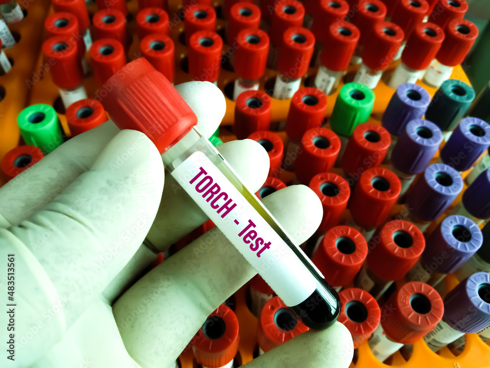 Blood sample for TORCH test, TORCH Panel Test. Toxoplasmosis, Rubella