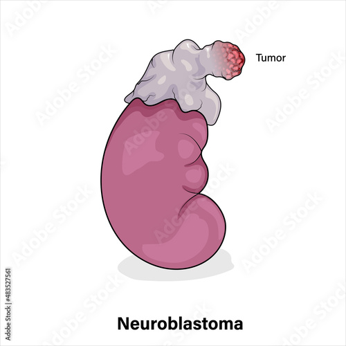 Neuroblastoma and Kidney Cancer, Vector Illustration on White Background for Medical Education and Research in Oncology