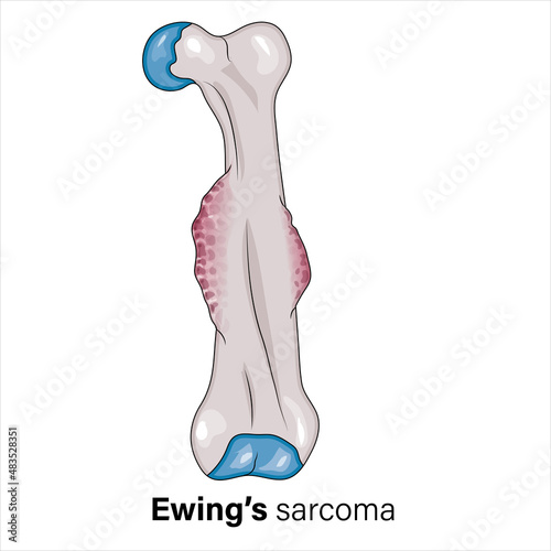 Ewing's Sarcoma Medical Illustration, Detailed Vector Art of Bone Cancer, Tumor Cells, Oncology Concept on White Background for Health Education and Research.